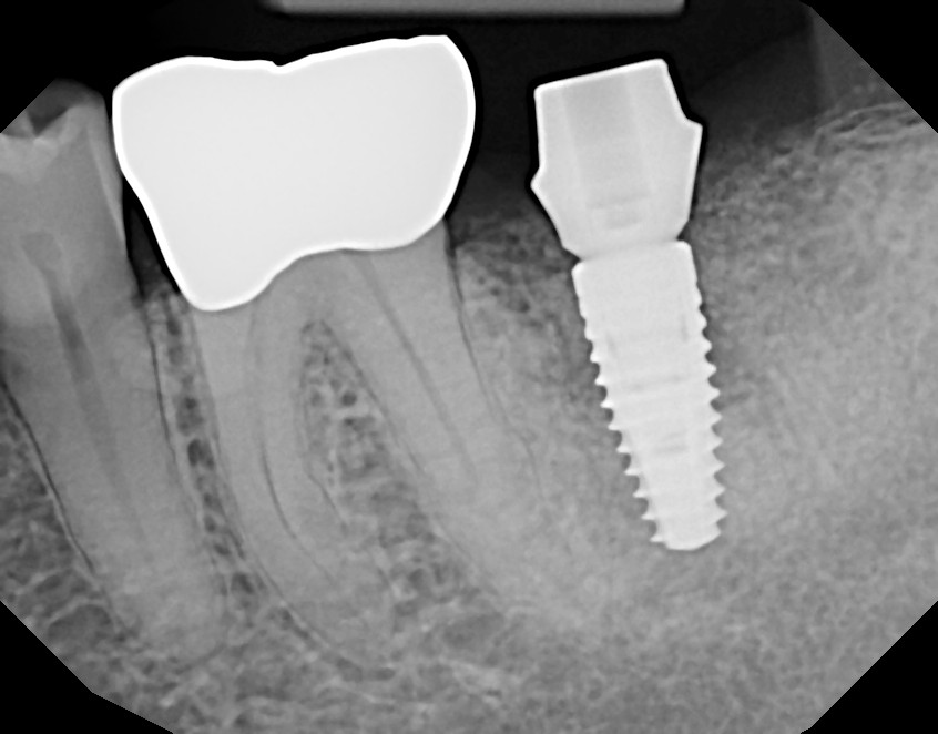 Abutment